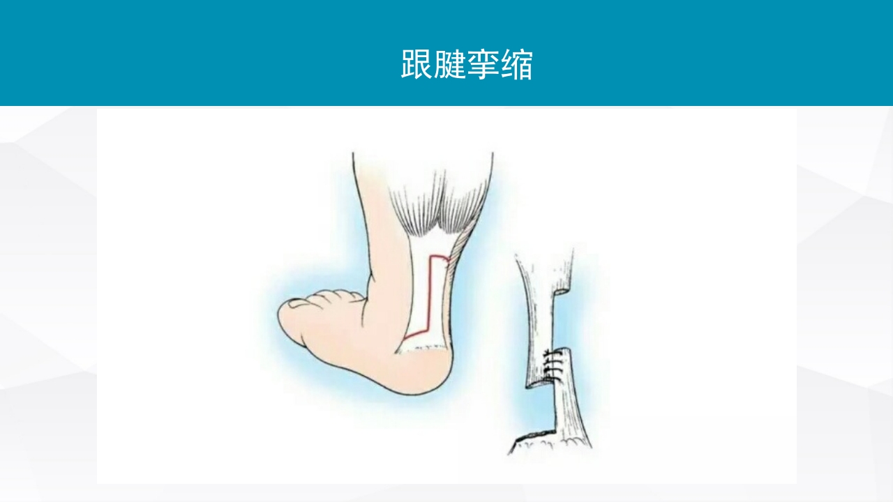 踝关节扭伤的评估和治疗PPT课件24