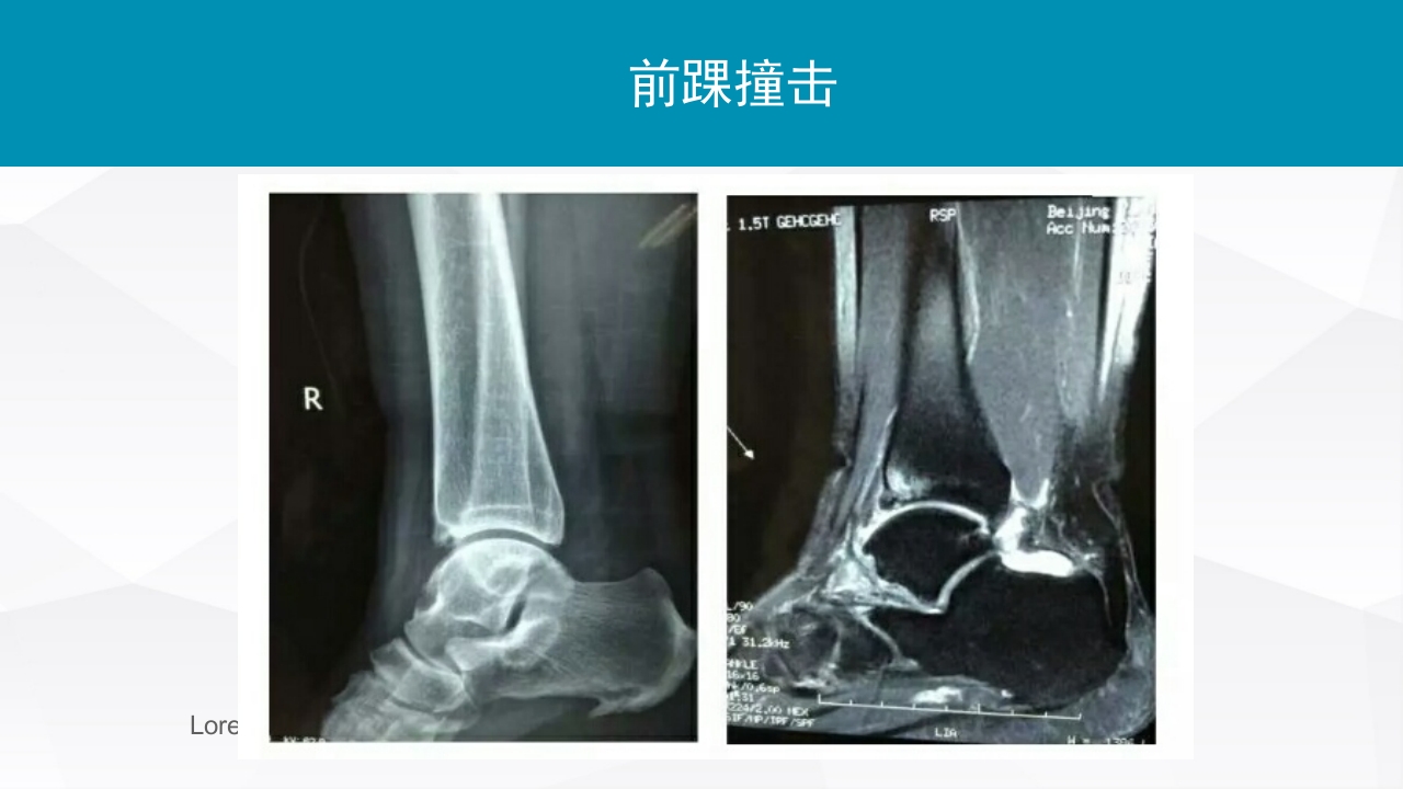 踝关节扭伤的评估和治疗PPT课件25