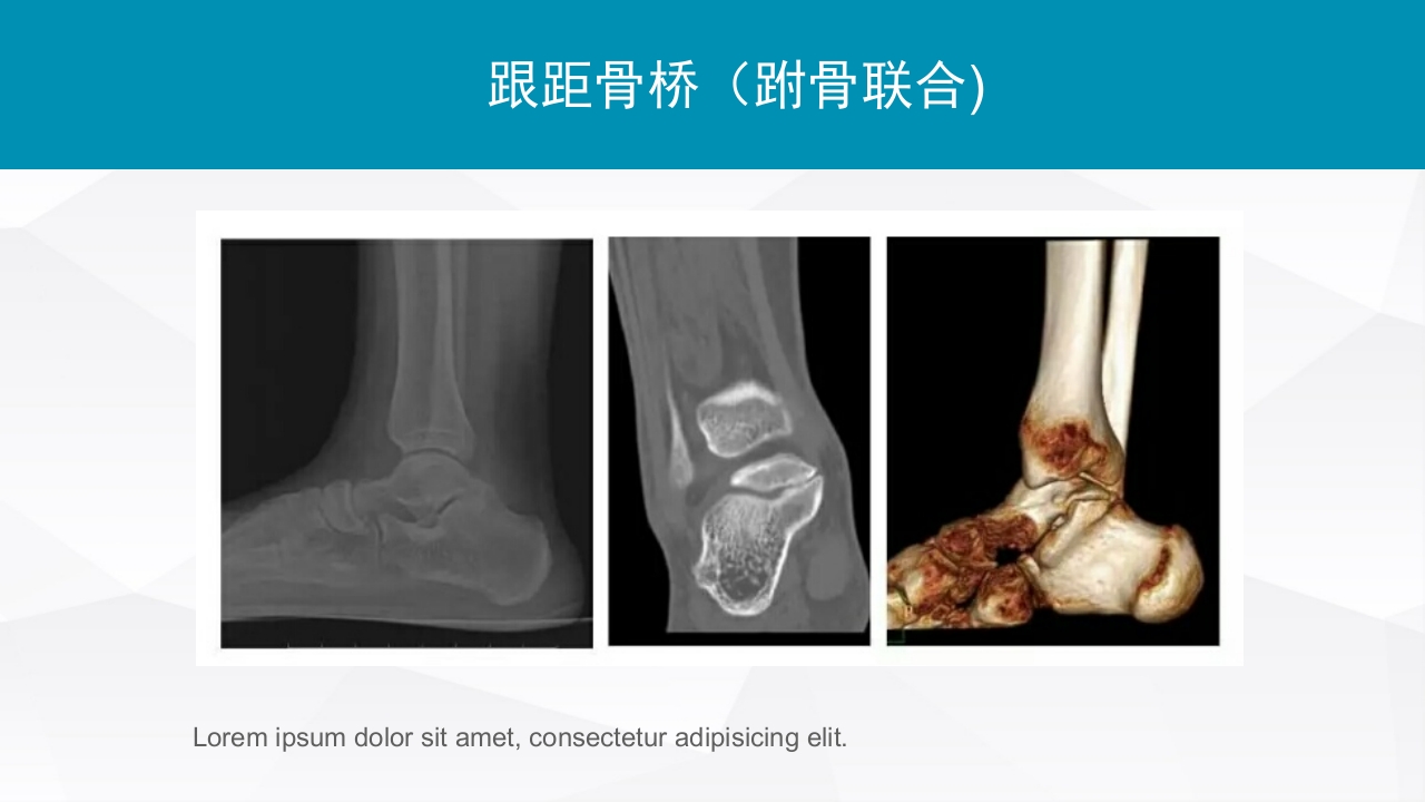 踝关节扭伤的评估和治疗PPT课件26
