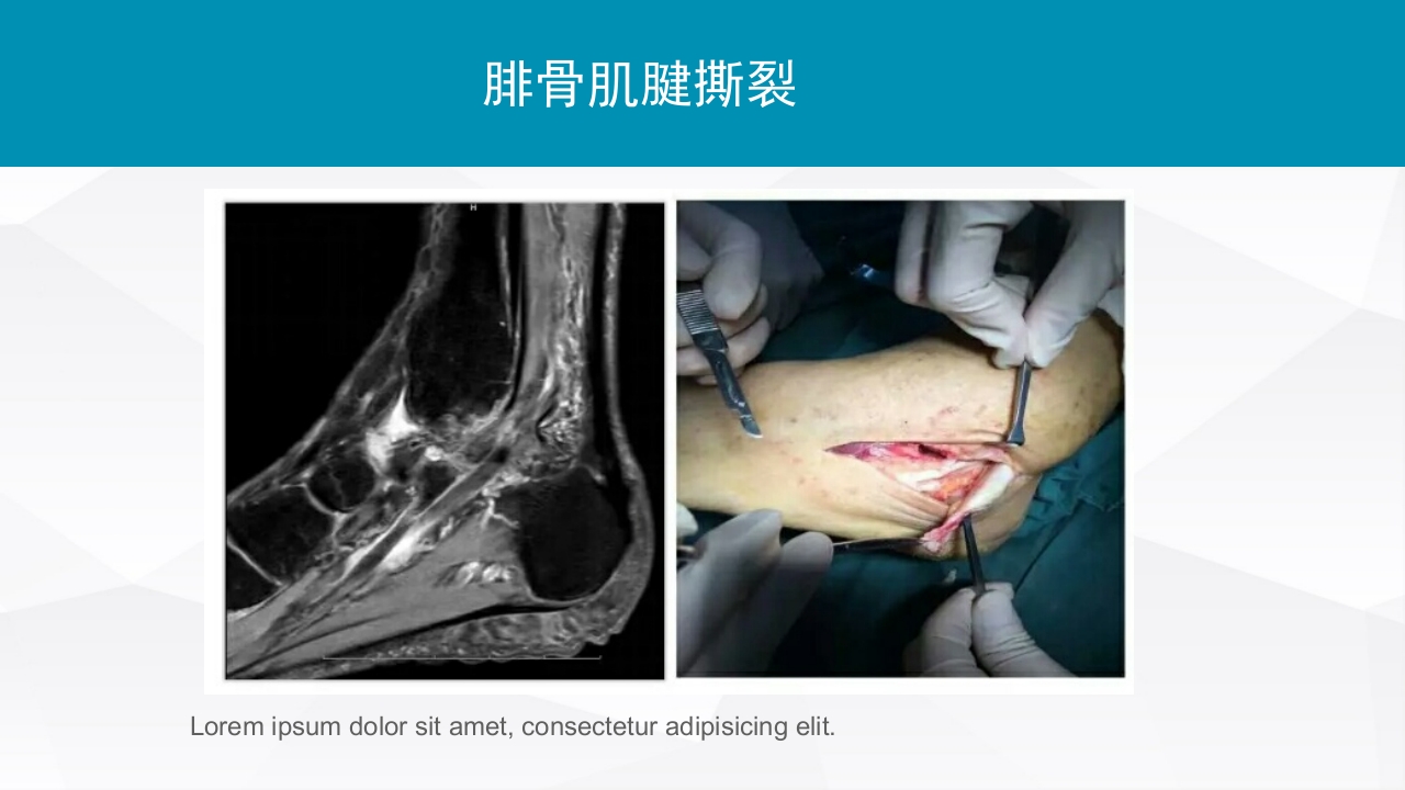 踝关节扭伤的评估和治疗PPT课件27