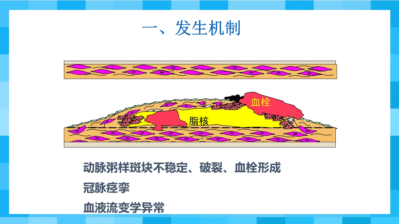 急性冠脉综合征PPT课件10