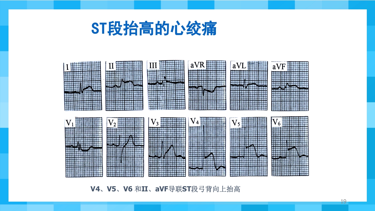 急性冠脉综合征PPT课件19