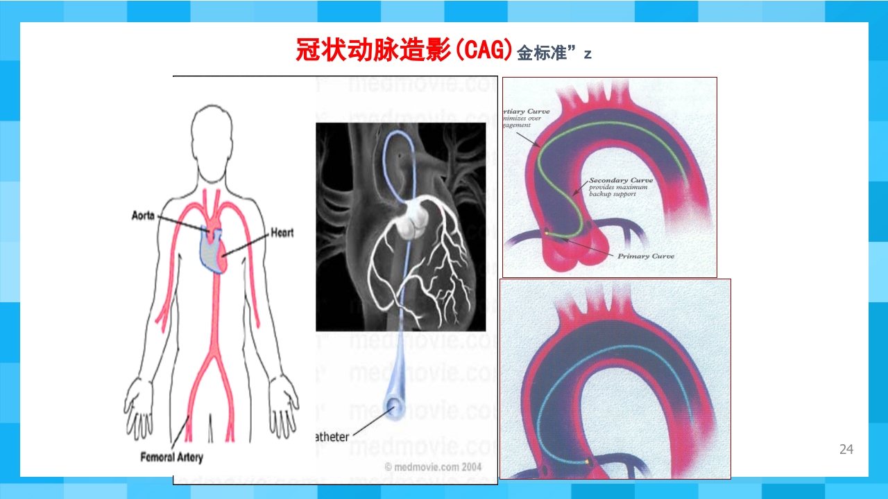 急性冠脉综合征PPT课件24