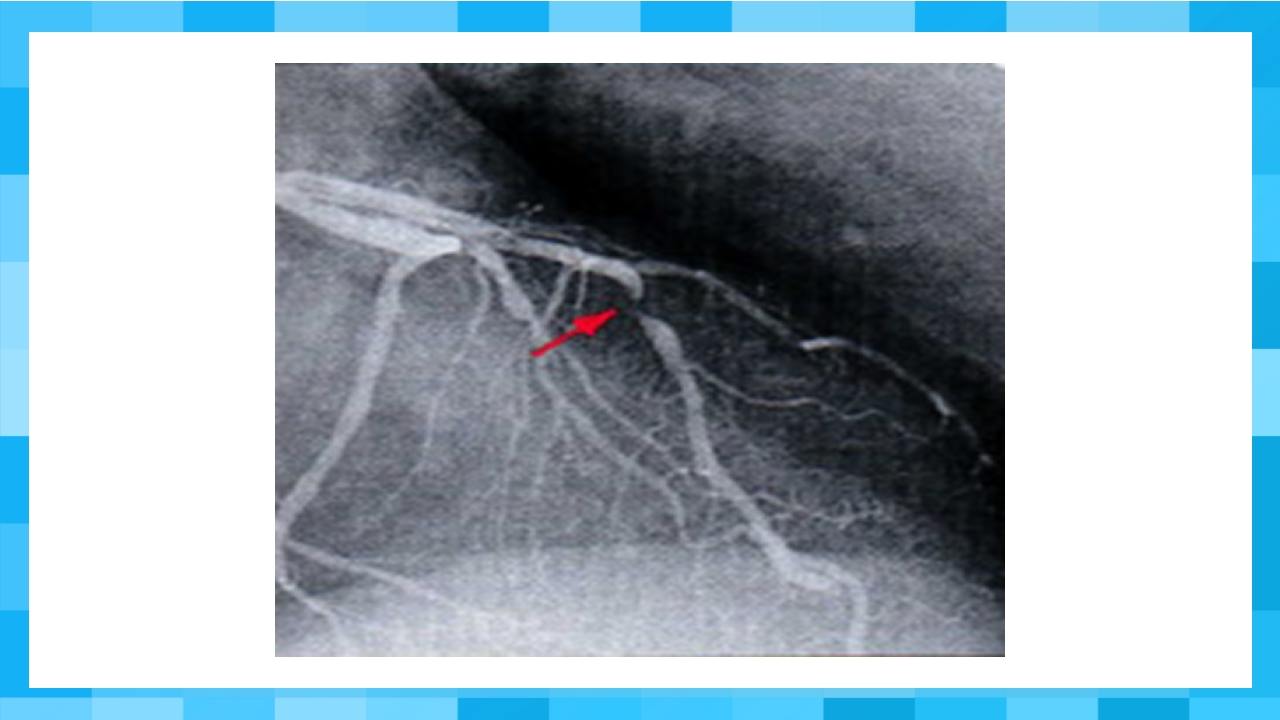 急性冠脉综合征PPT课件25