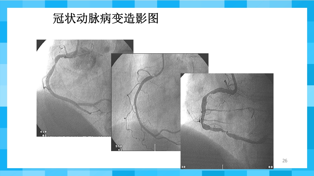急性冠脉综合征PPT课件26