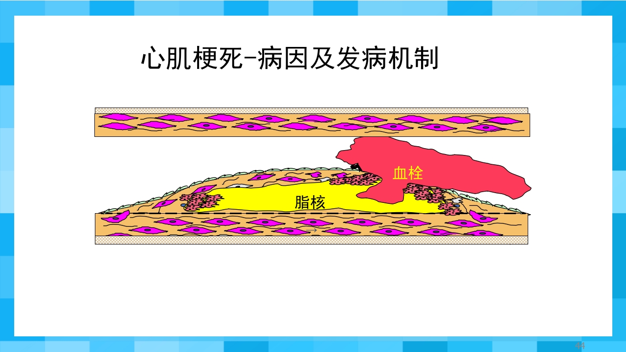 急性冠脉综合征PPT课件44