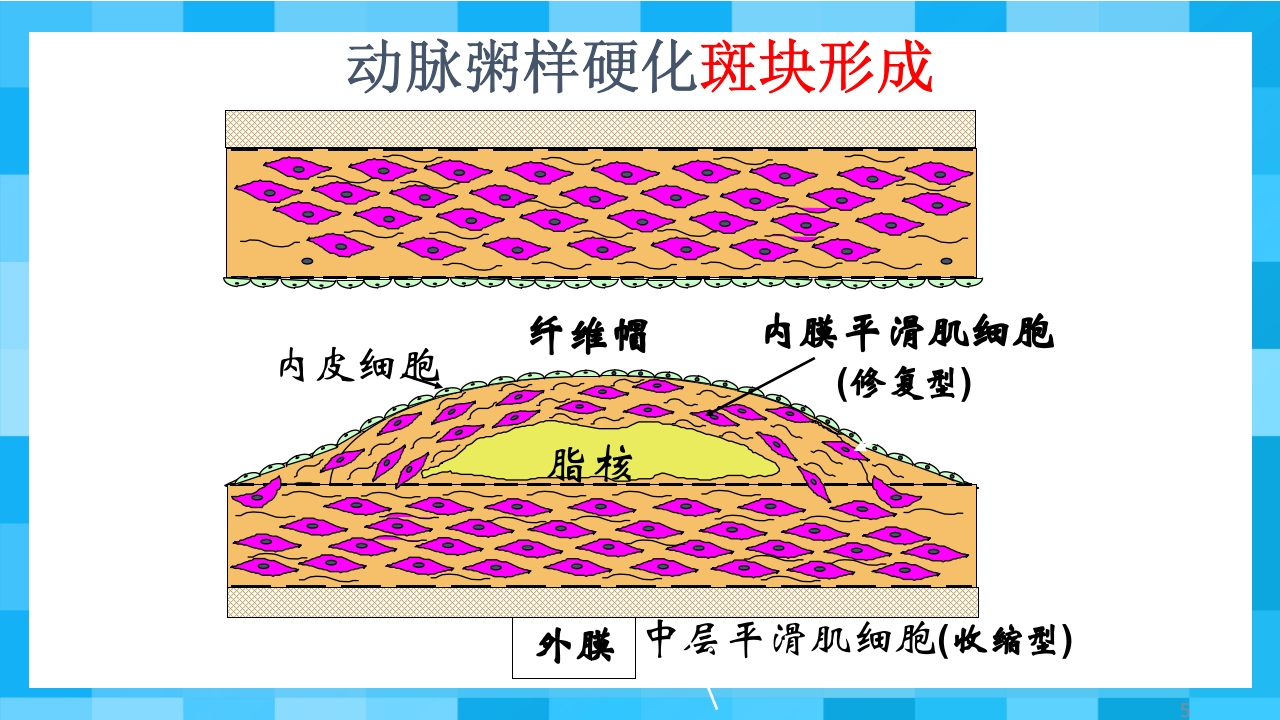 急性冠脉综合征PPT课件5