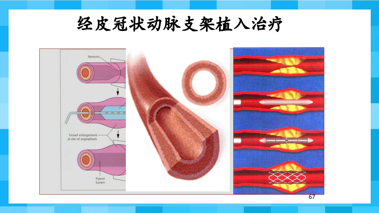 急性冠脉综合征PPT课件67