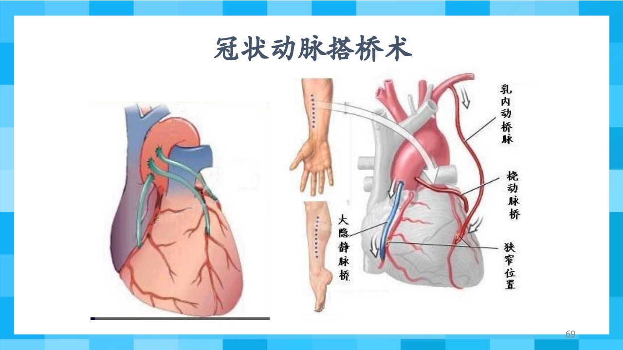 急性冠脉综合征PPT课件69