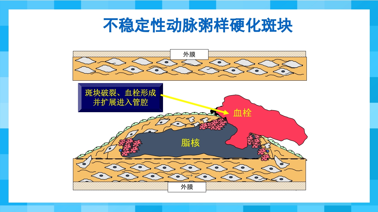 急性冠脉综合征PPT课件6