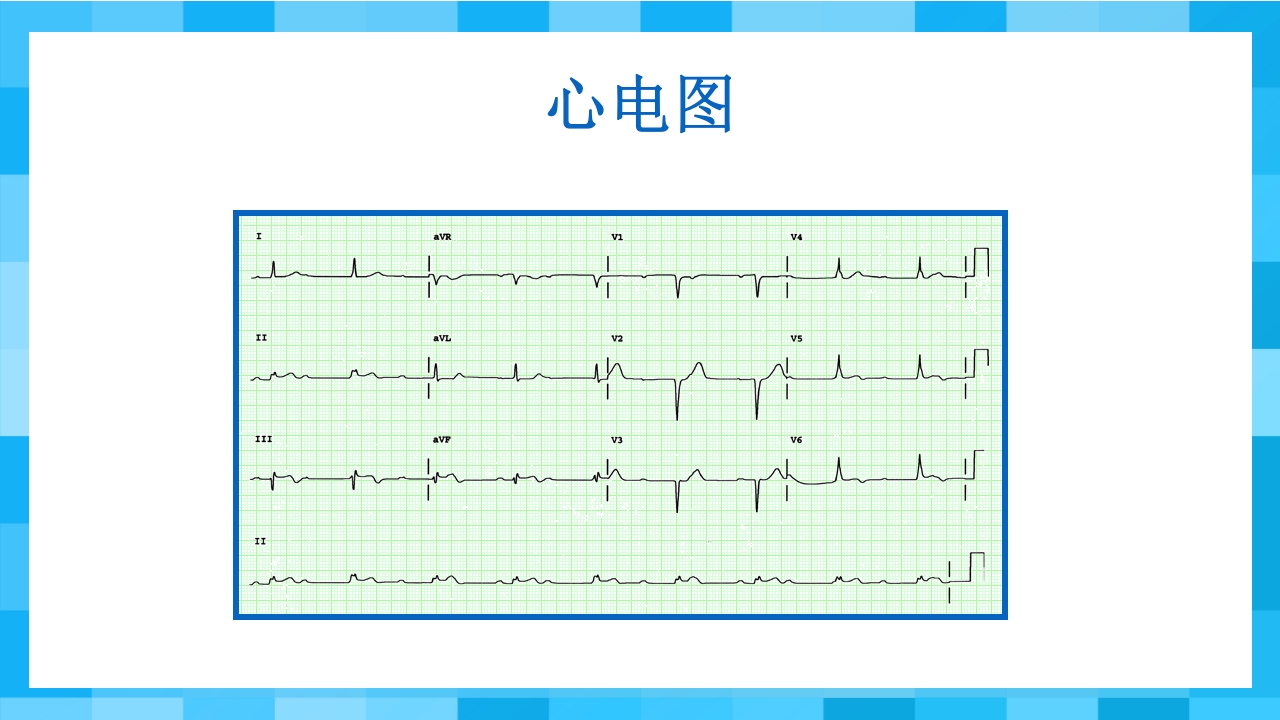 急性冠脉综合征PPT课件72
