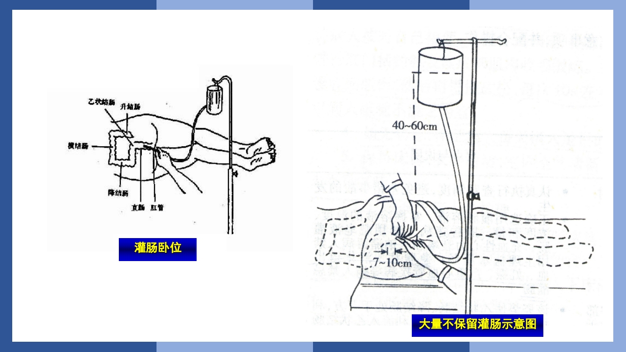 鼻饲、灌肠、导尿术PPT课件30