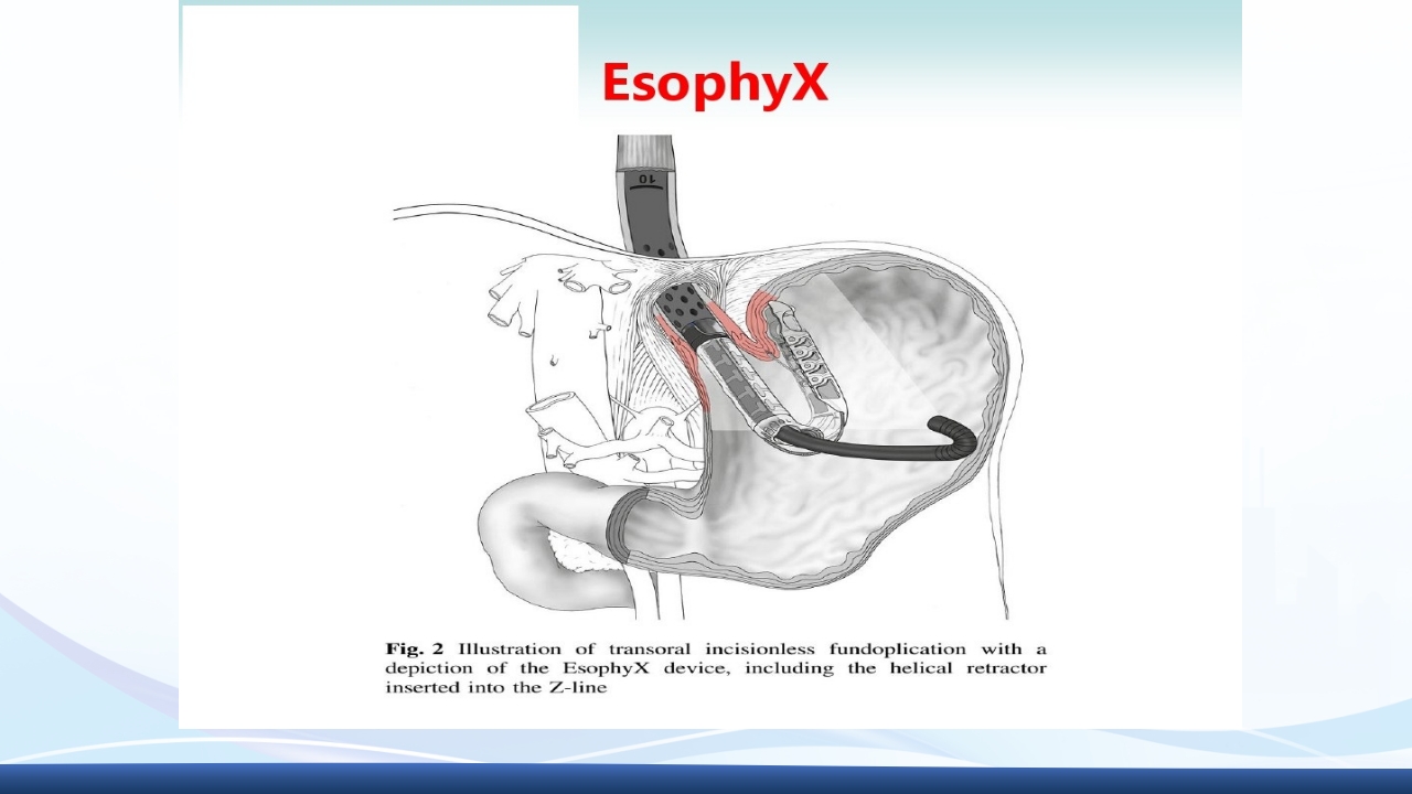 胃食管反流PPT课件46