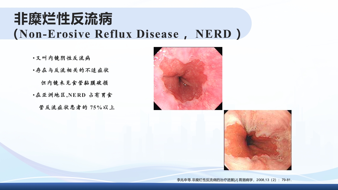 胃食管反流PPT课件5