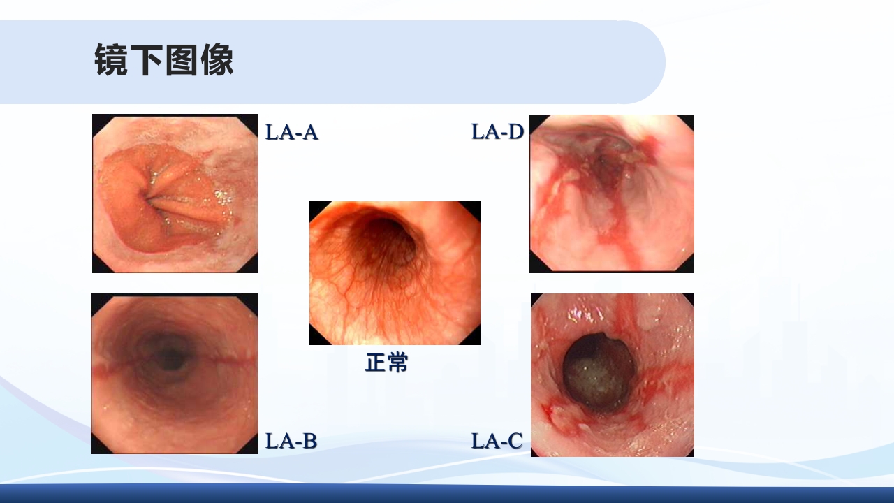 胃食管反流PPT课件8