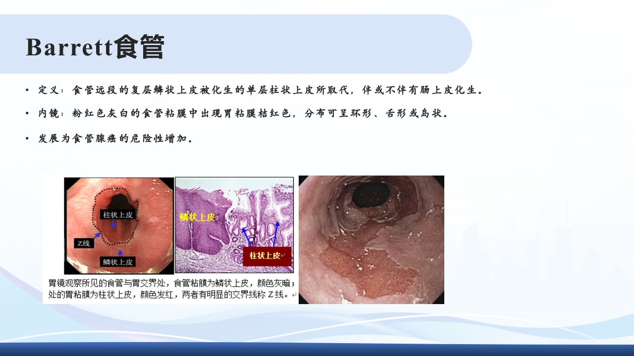 胃食管反流PPT课件9