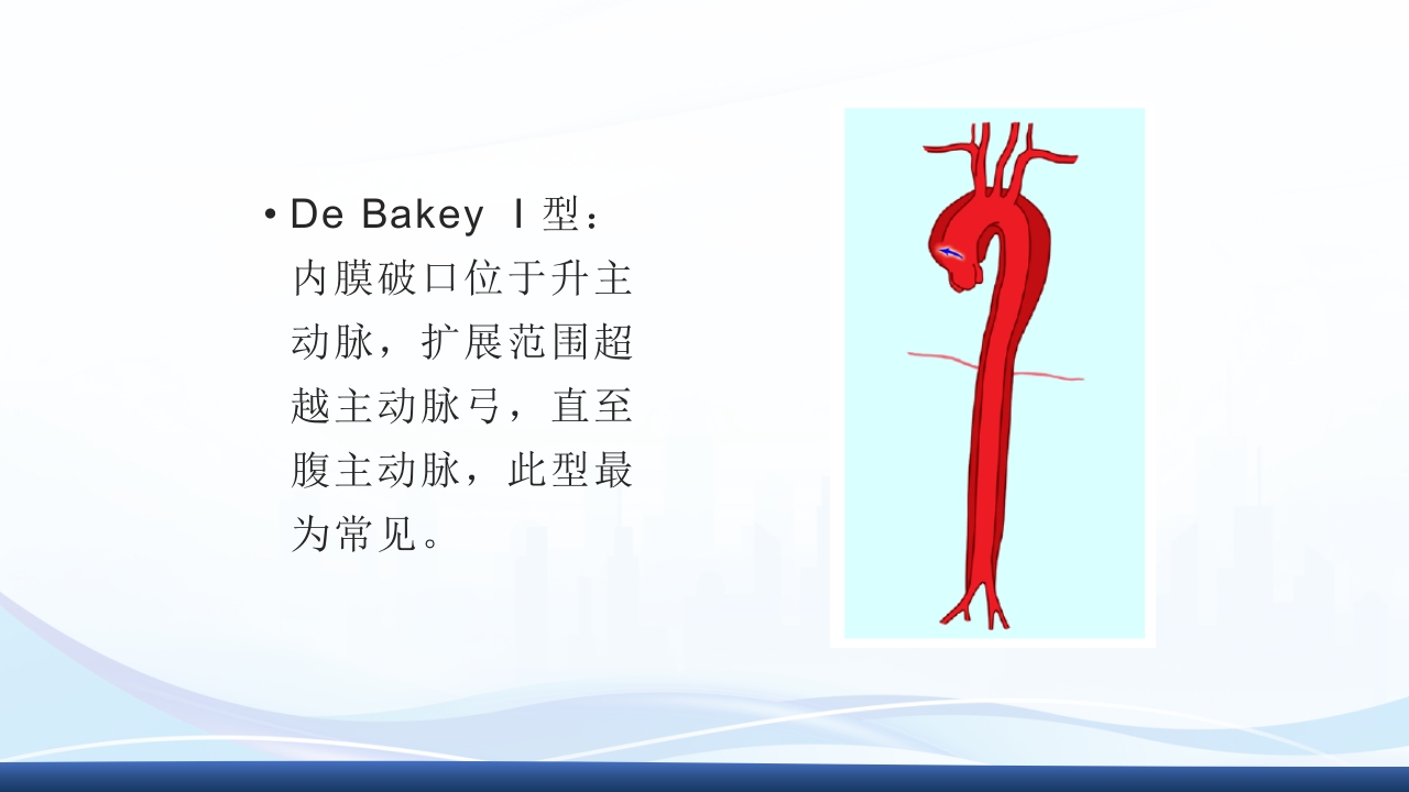 主动脉夹层护理查房PPT课件下载12