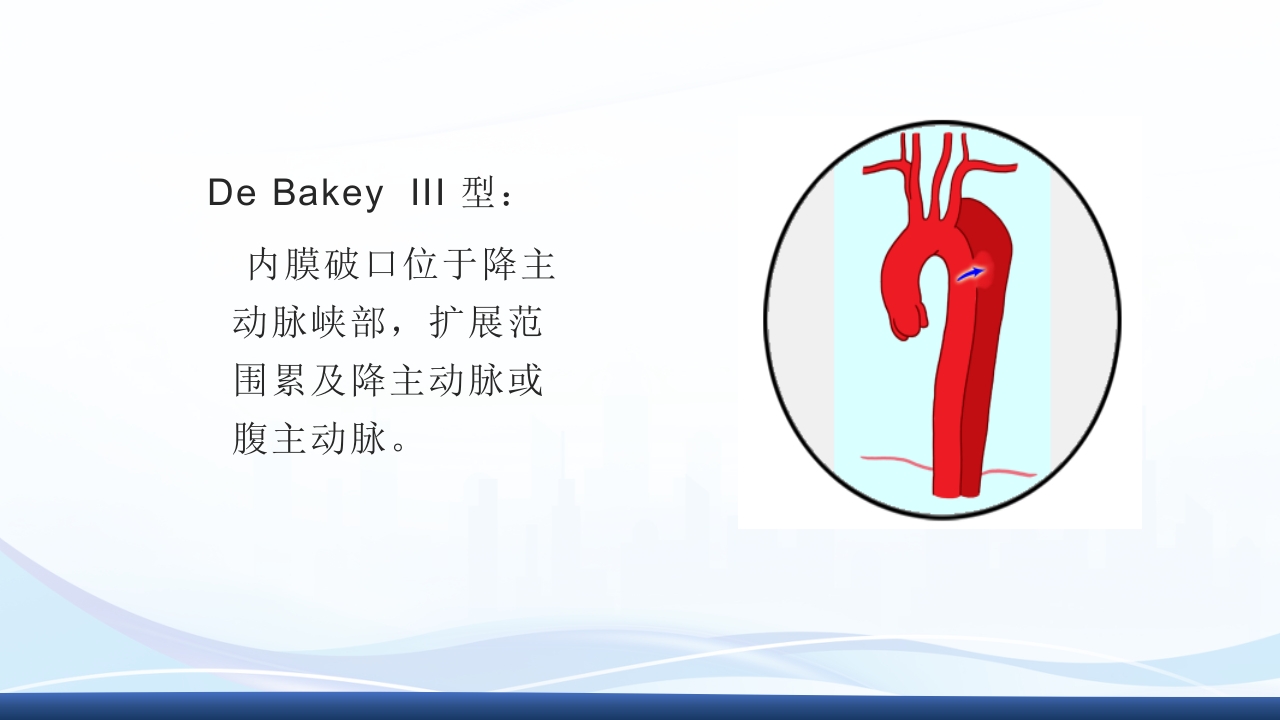 主动脉夹层护理查房PPT课件下载14