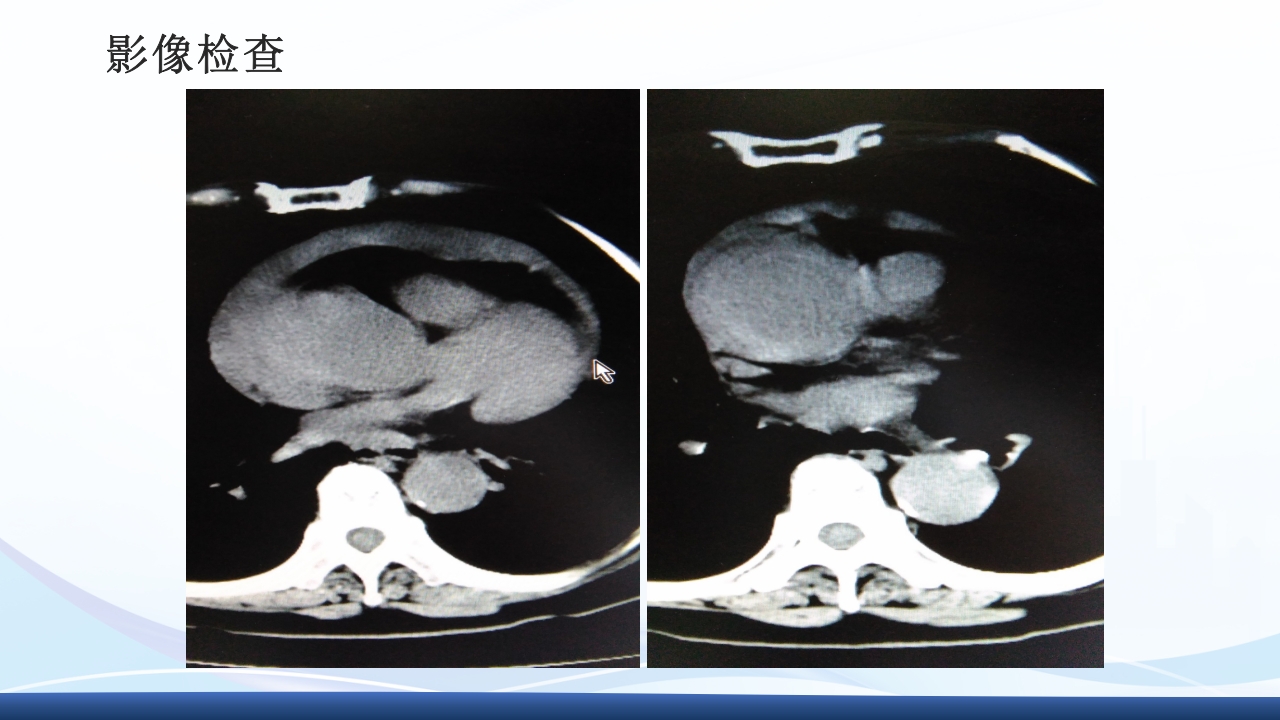 主动脉夹层护理查房PPT课件下载34