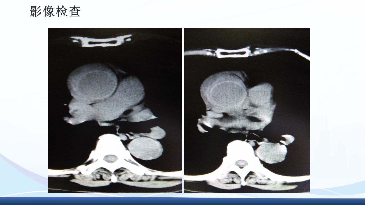 主动脉夹层护理查房PPT课件下载35