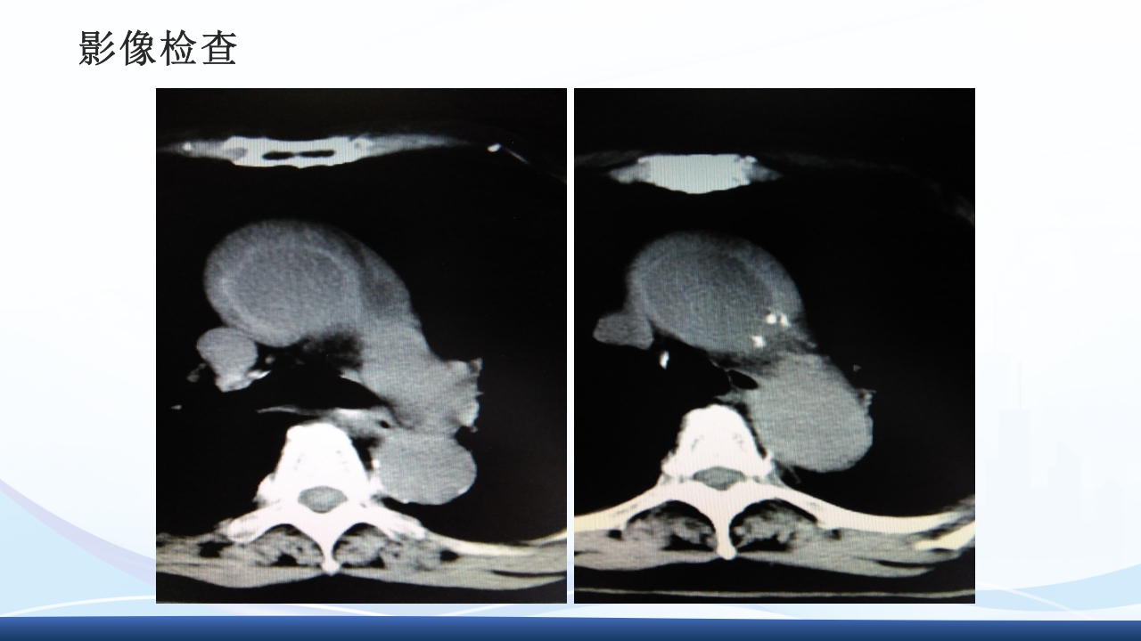 主动脉夹层护理查房PPT课件下载36