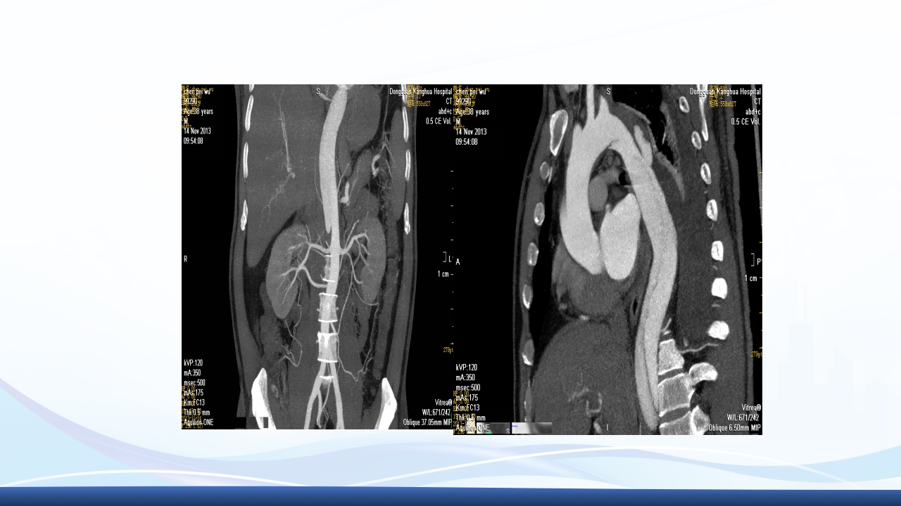 主动脉夹层护理查房PPT课件下载37