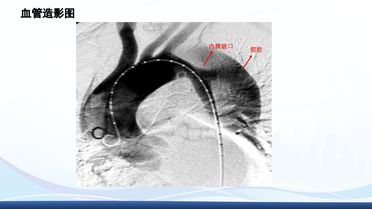 主动脉夹层护理查房PPT课件下载38
