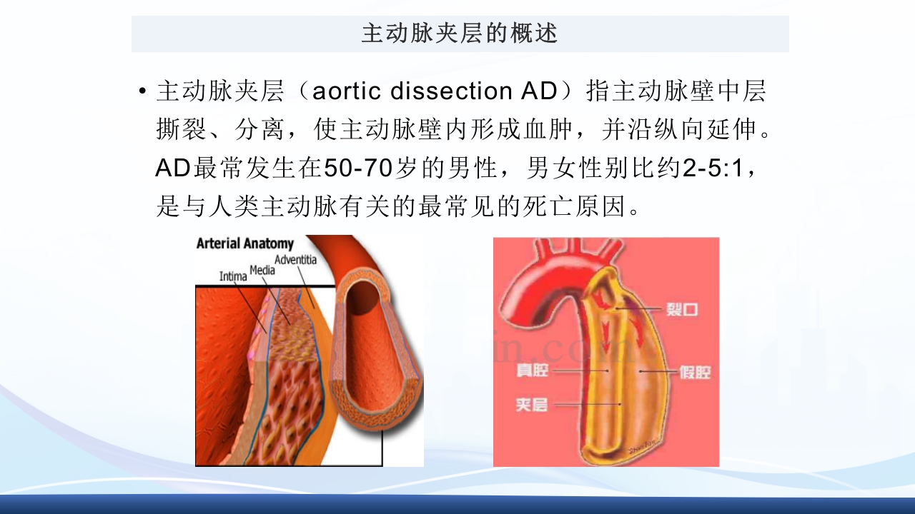 主动脉夹层护理查房PPT课件下载5