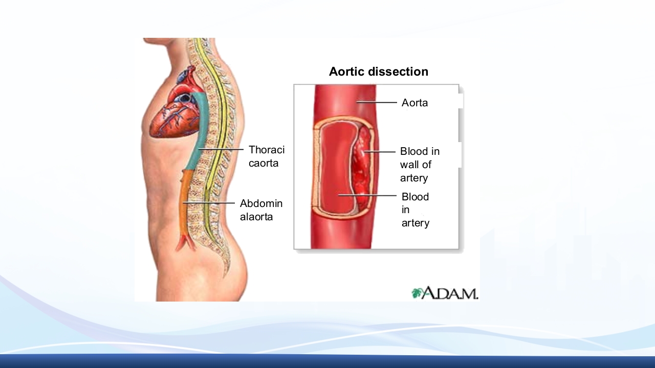 主动脉夹层护理查房PPT课件下载6