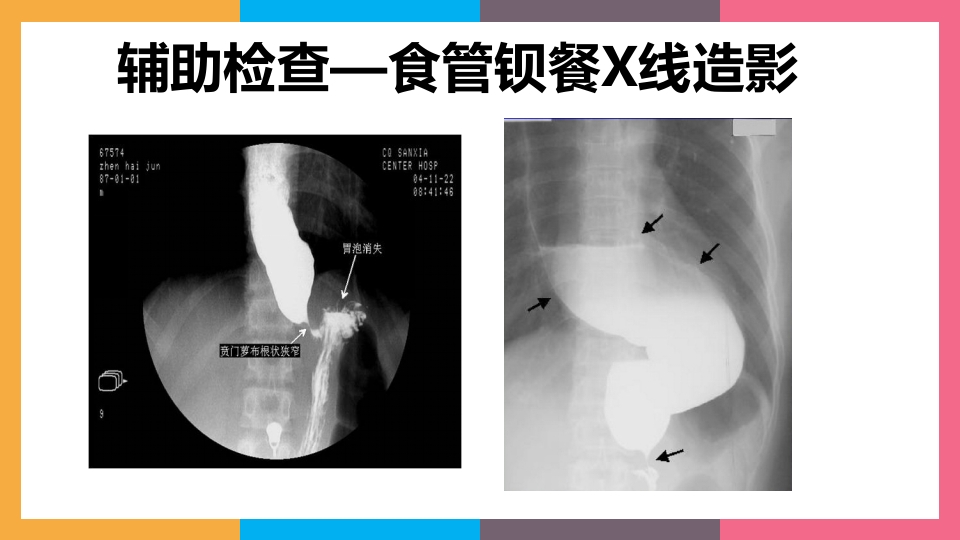 贲门失弛缓症治疗与护理PPT课件11
