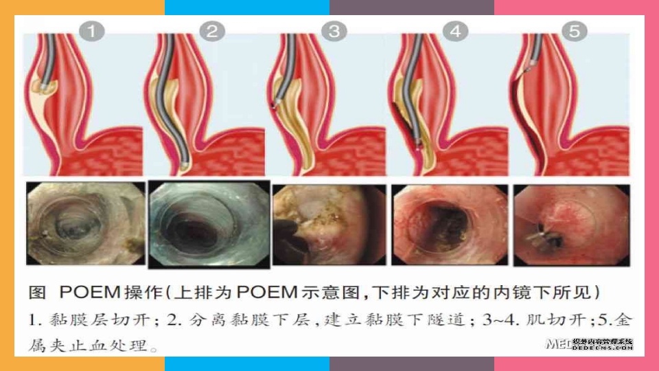 贲门失弛缓症治疗与护理PPT课件19