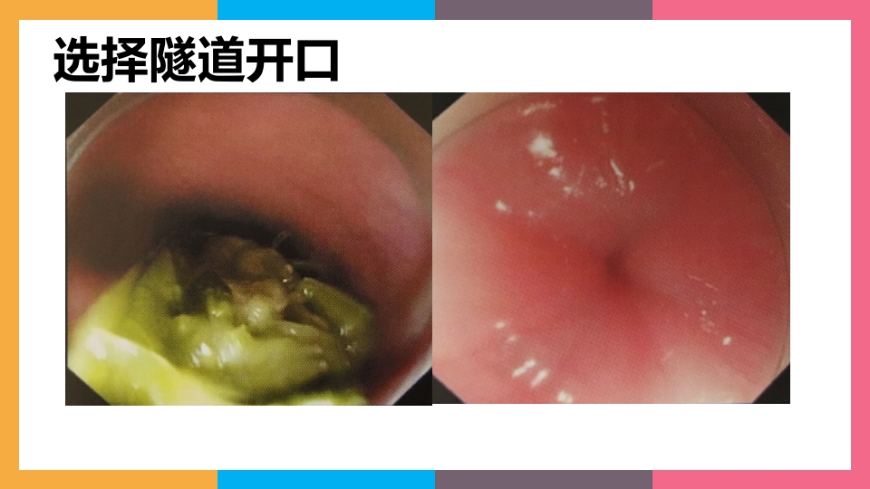 贲门失弛缓症治疗与护理PPT课件20