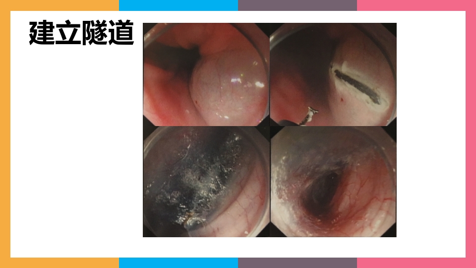 贲门失弛缓症治疗与护理PPT课件21