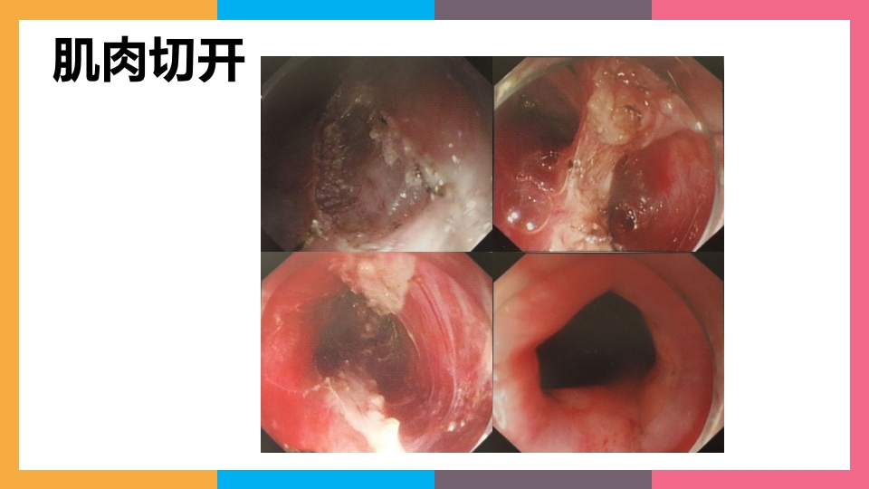 贲门失弛缓症治疗与护理PPT课件22
