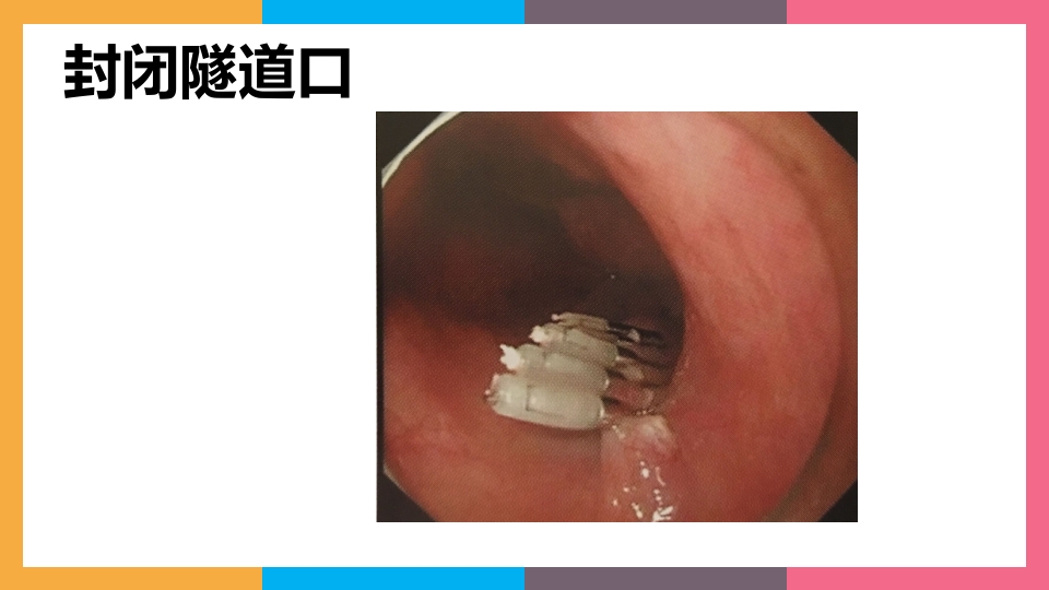 贲门失弛缓症治疗与护理PPT课件23