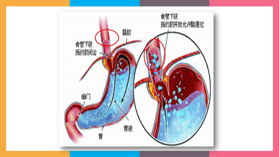 贲门失弛缓症治疗与护理PPT课件5