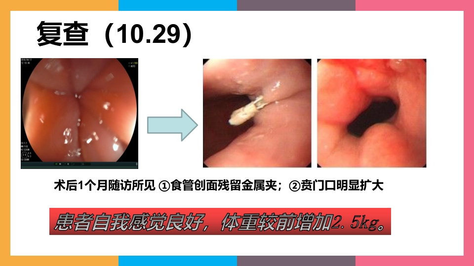 贲门失弛缓症治疗与护理PPT课件67