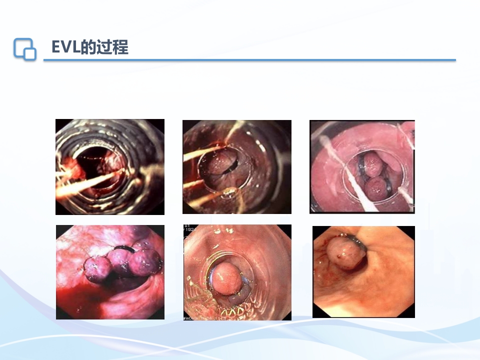 肝硬化内镜下治疗及护理ppt课件14
