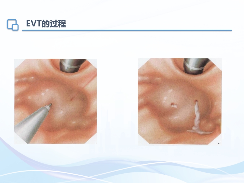 肝硬化内镜下治疗及护理ppt课件19