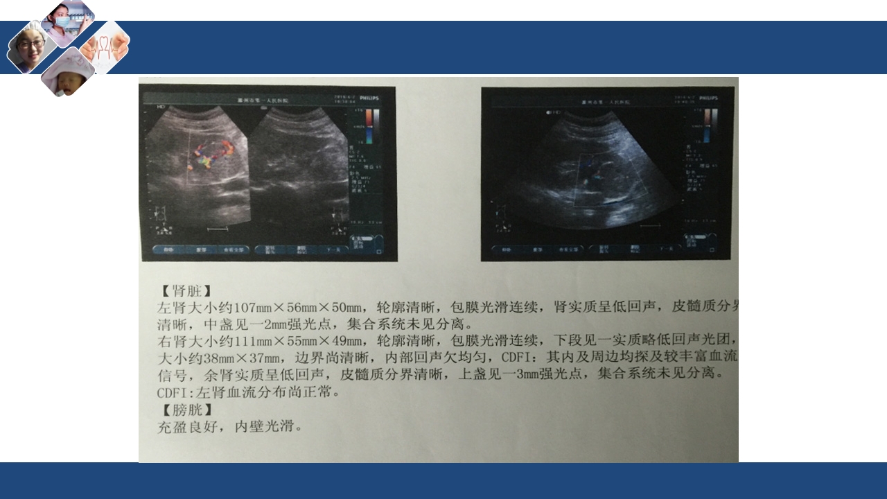 肾切除护理查房PPT课件下载12