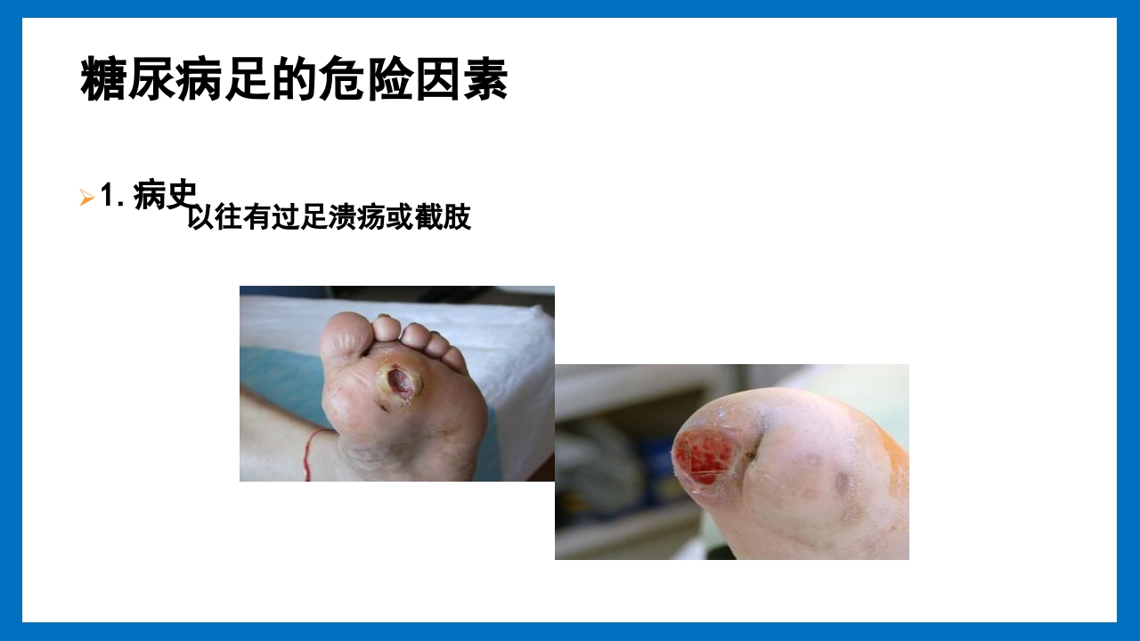 糖尿病足的预防和护理小讲课PPT8