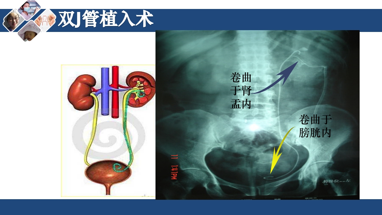 双J管的护理PPT课件10