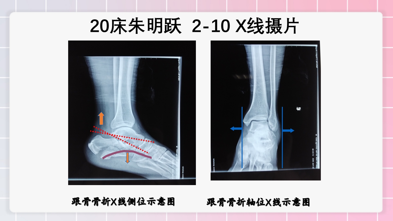 跟骨骨折个案护理PPT课件15