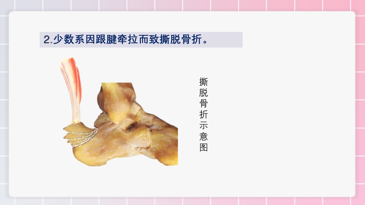 跟骨骨折个案护理PPT课件20