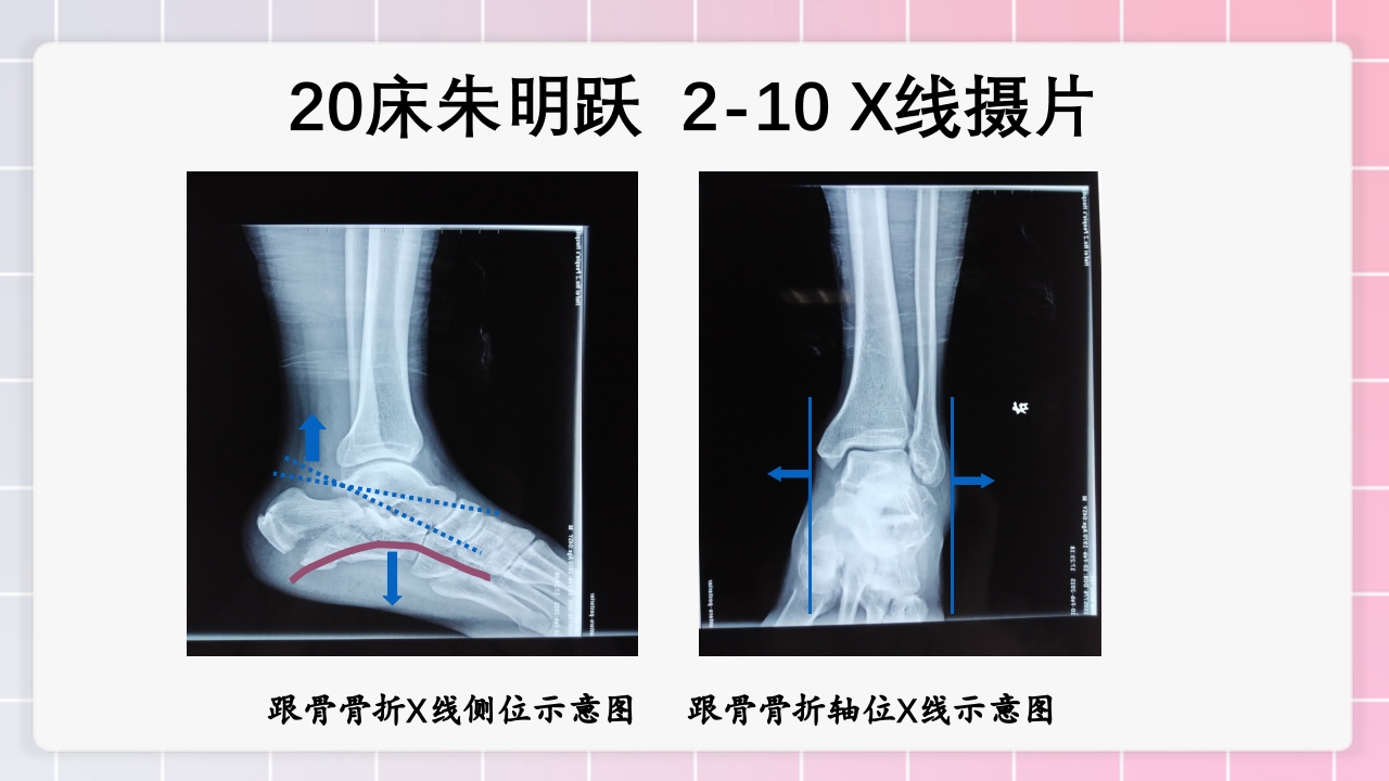 跟骨骨折个案护理PPT课件21