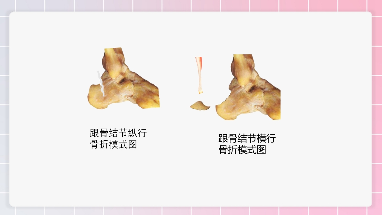 跟骨骨折个案护理PPT课件23
