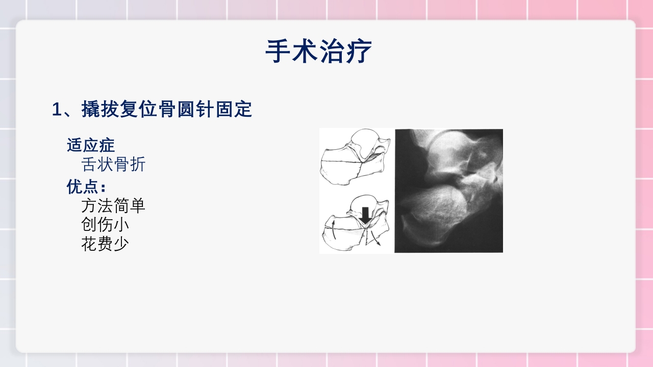 跟骨骨折个案护理PPT课件26