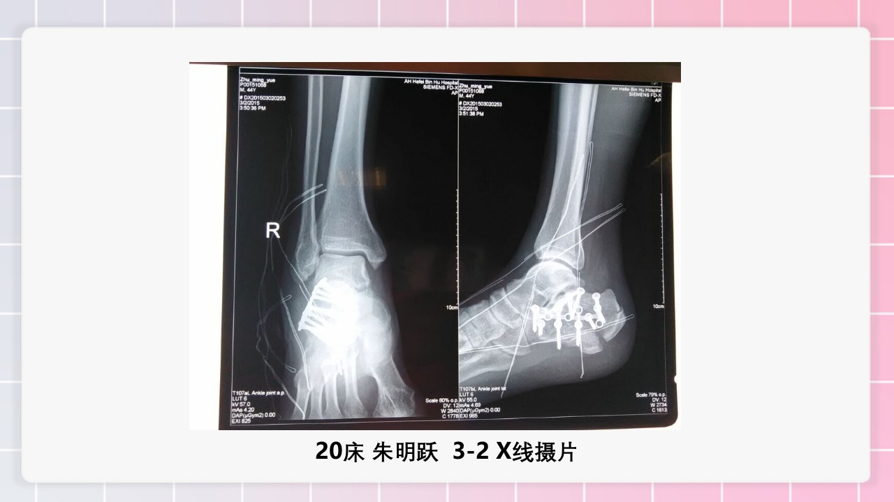 跟骨骨折个案护理PPT课件30