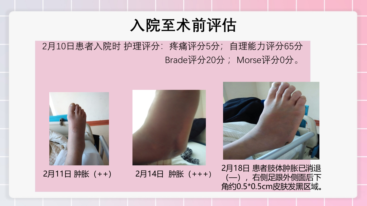 跟骨骨折个案护理PPT课件32