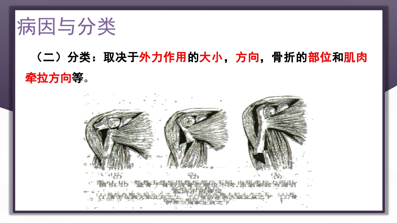 上肢骨关节损伤PPT课件25